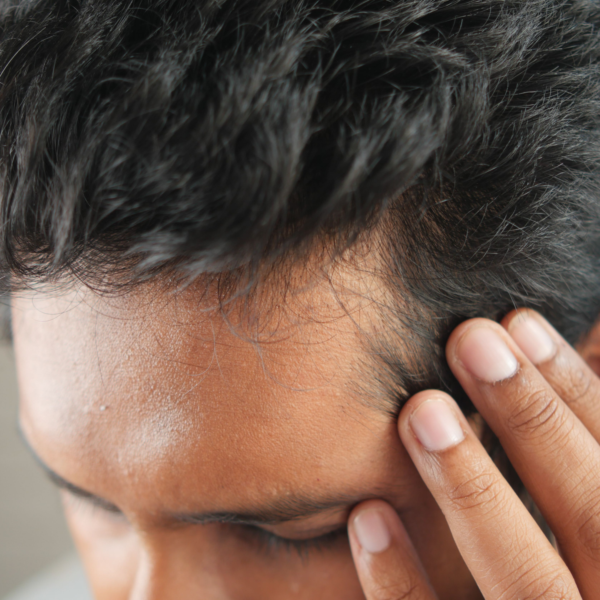 Hair thinning