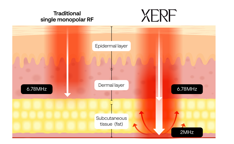 Diagram showing XERF dual-frequency radiofrequency delivery at multiple skin depths